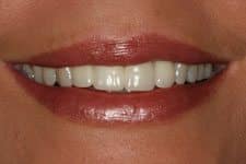 Cosmetic Dental Female Smile Bridge After Salt Lake City