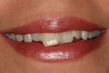 Cosmetic Dental Female Smile Bridge Before Salt Lake City