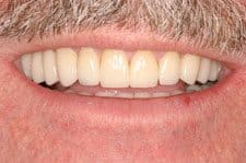 Cosmetic Dental Full Mouth Reconstruction After Salt Lake City Dentist