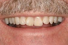 Cosmetic Dental Full Mouth Reconstruction Before Salt Lake City Dentist
