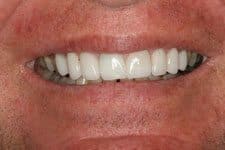 Cosmetic Dental Male Smile Makeover After Salt Lake City