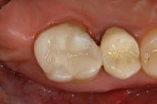 Cosmetic Dental Tooth Colored Filling After Salt Lake City