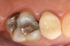 Cosmetic Dental Tooth Colored Filling Before Salt Lake City