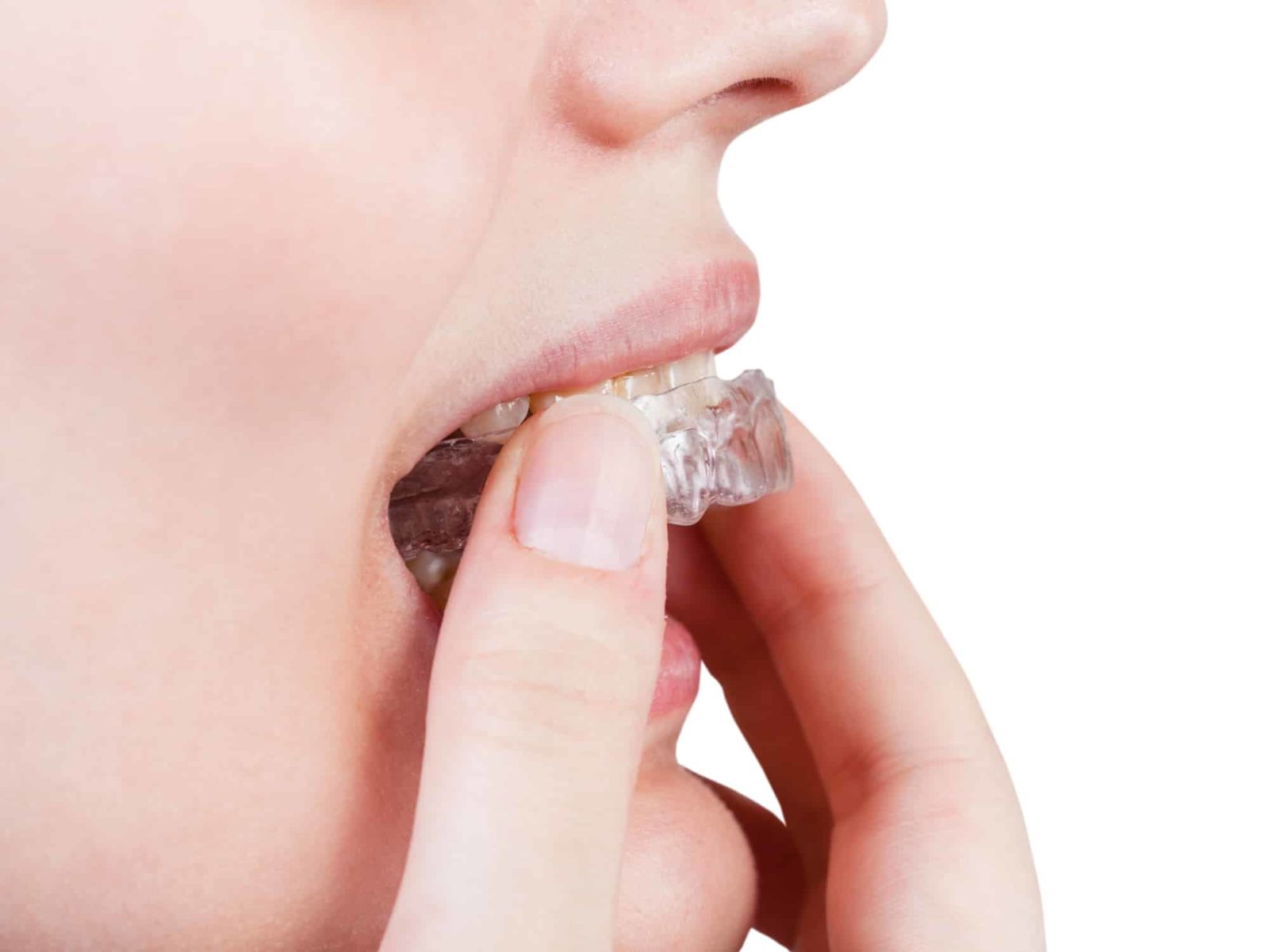 Invisalign Dentist SLC UT