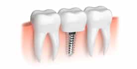 Dental Implants Salt Lake City UT