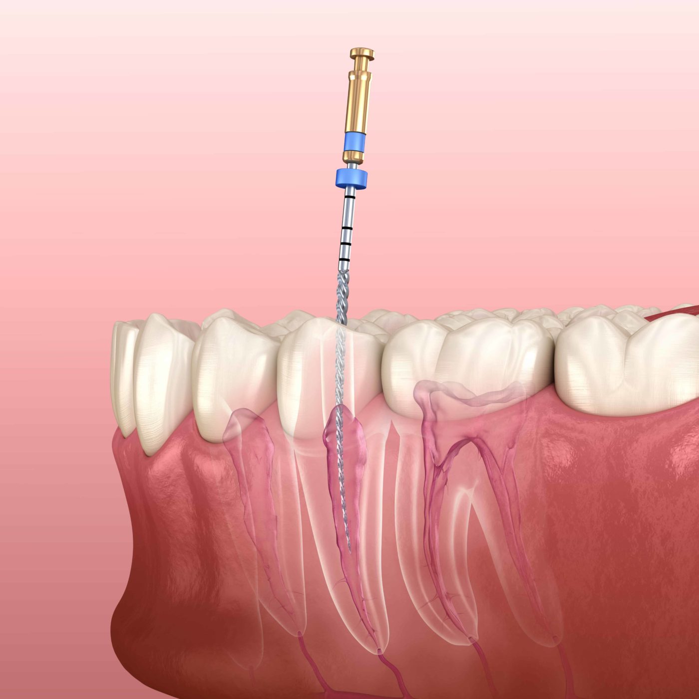 What Happens During Root Canals? root canals Avenues Dentistry Salt Lake City Utah Dental Office