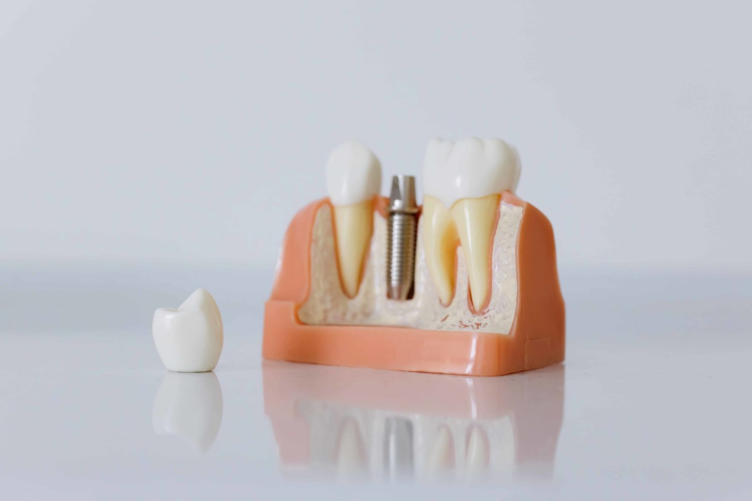 dental implants Avenues Dentistry Salt Lake City Utah Dental Office