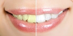 safe to whiten your teeth