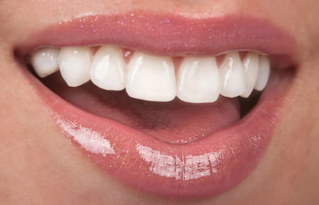 How Do You Prepare For Your Veneers? 5 Steps To Ensure Their Success Prepare for your veneers in Salt Lake City, Utah